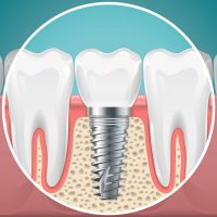 dental implants