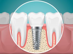 dental implants