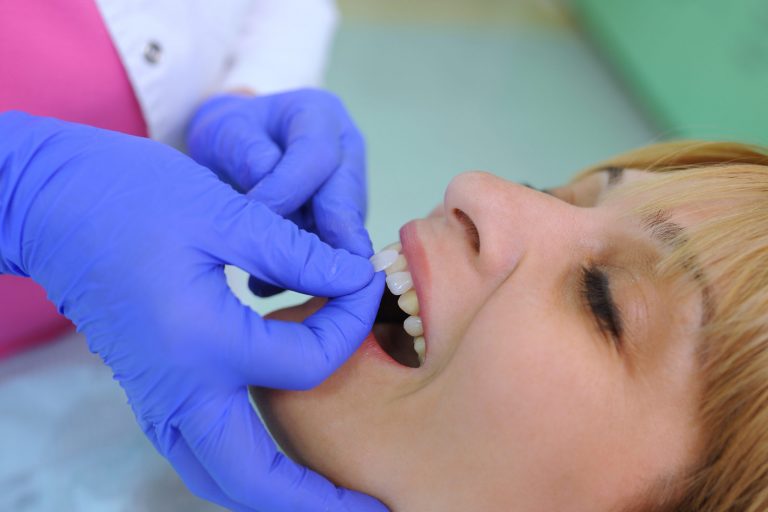 Nerve pain after veneers. Do veneers pain? Sola Dental Spa