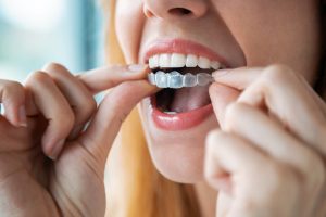 Invisalign staten island