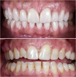 insurance for veneers 