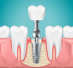 dental implants aftercare