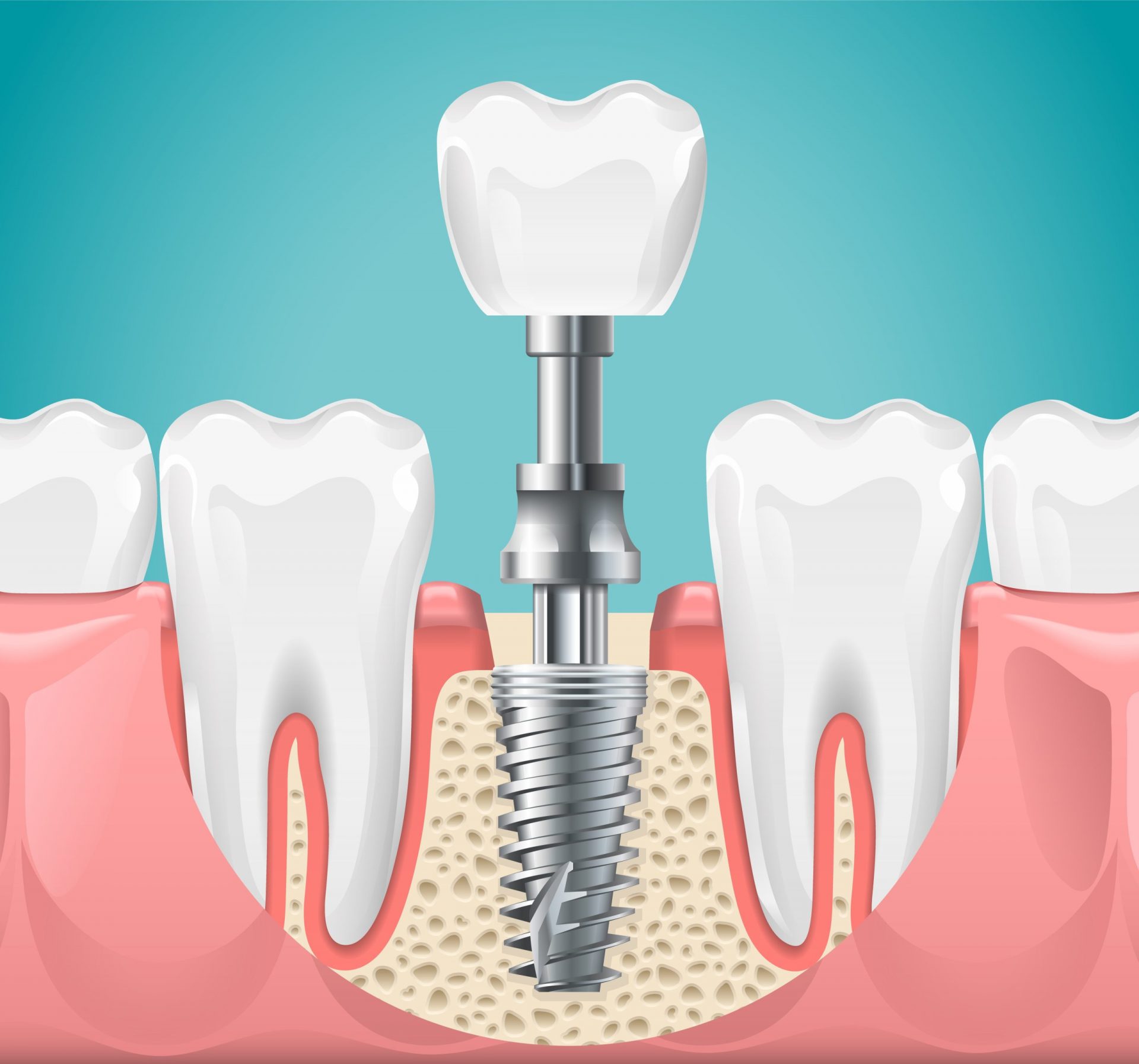 Dental implants aftercare. How to care for implants? Sola Dental Spa