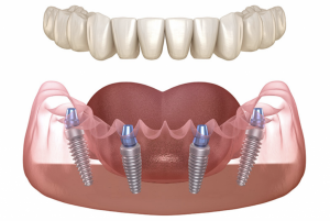 all on 4 dental implants