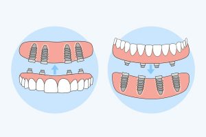 best type of dental implants