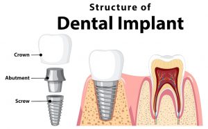 best type of implants