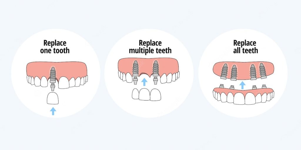 types of dental implants