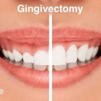 Gum surgery aftercare. What to do after a gingivectomy?