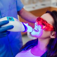 Questions to Ask Yourself Before Getting Teeth Whitening