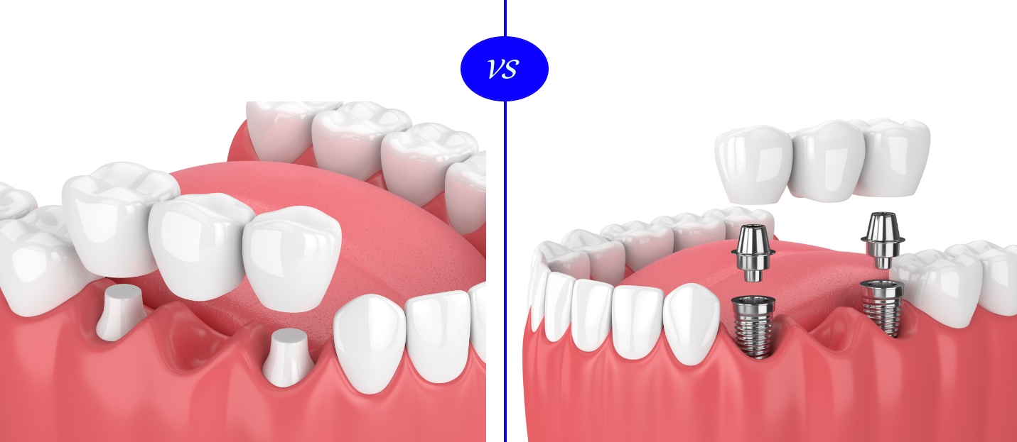 tooth bridge vs implant