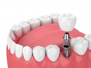 dental bridge vs implant