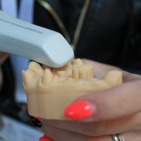 How long does a dental filling last?