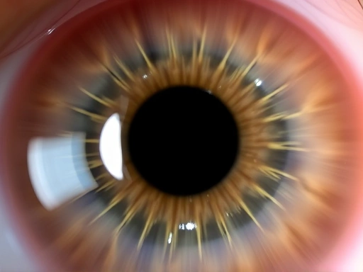 Close-up view of a human cornea with subtle white protein deposits visible under a microscope, illustrating Avellino Corneal Dystrophy before LASIK surgery. The image should convey precision and medical detail, highlighting the tiny opacities.