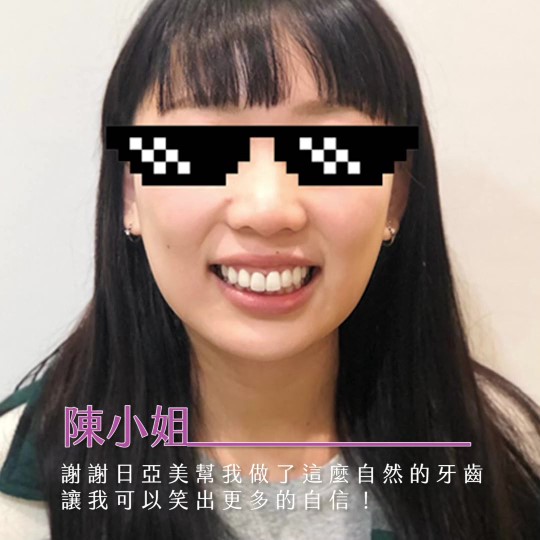 [職人瓷貼片] 蛀牙、缺角、色素沈澱通通 OUT!! 成功改善我牙縫過大的問題～我很滿意我現在的笑容！