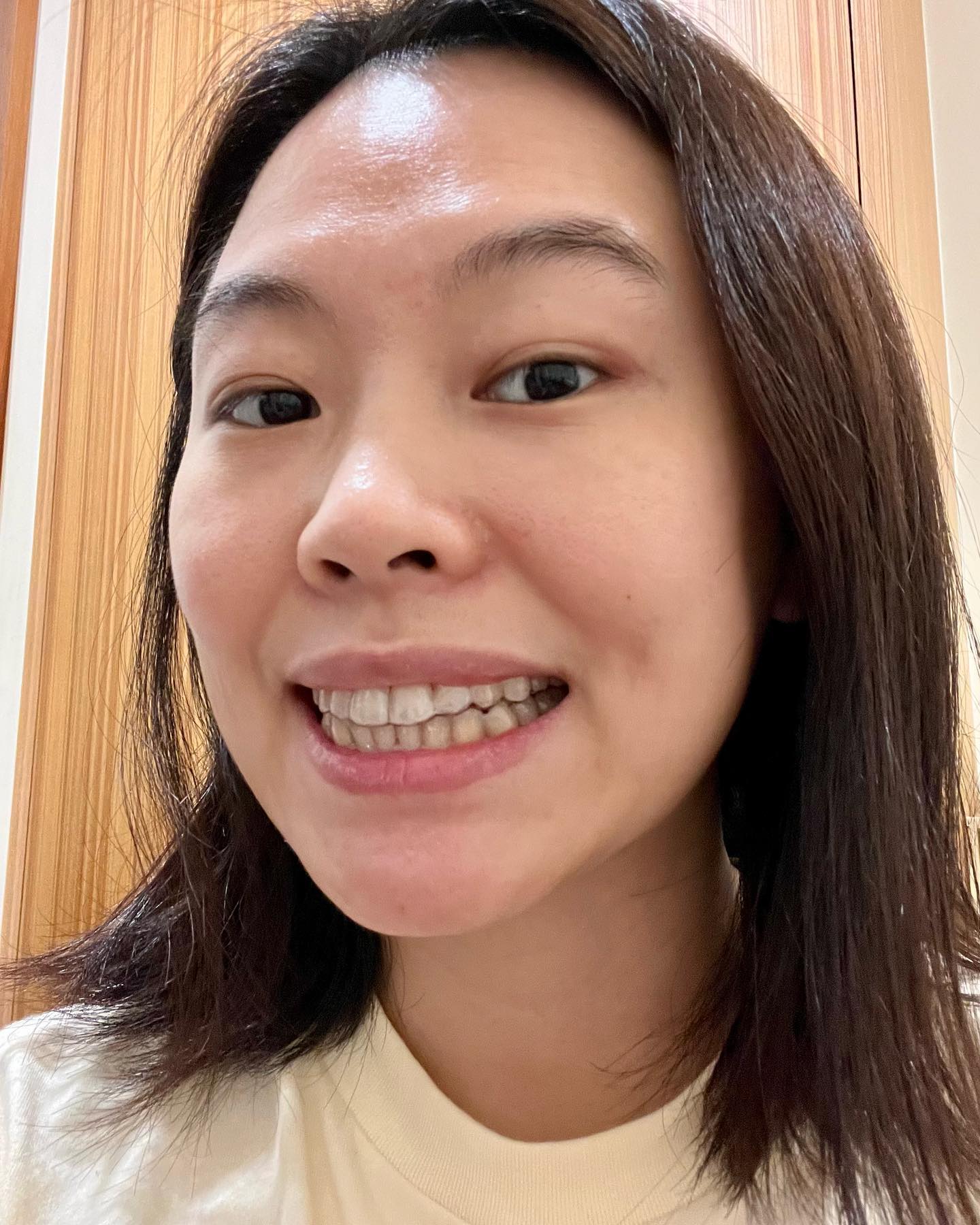 [樂齒 x 李脩琦] 我要給大家看一下花大錢的結果啦。2021/10開始我的大門牙微矯正，2023/3完成戴牙套的過程，我一直很在意的右邊大門牙終於是歸隊了