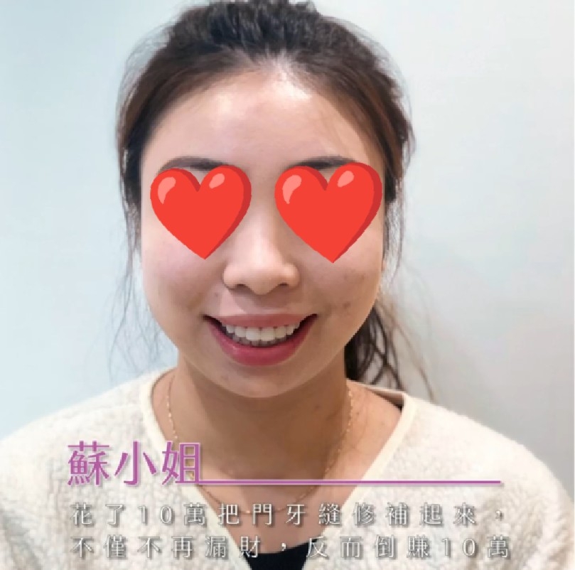 [職人瓷貼片]  在日亞美牙醫診所修補牙縫打造完美牙齒，不僅不再漏財、還倒賺回來！