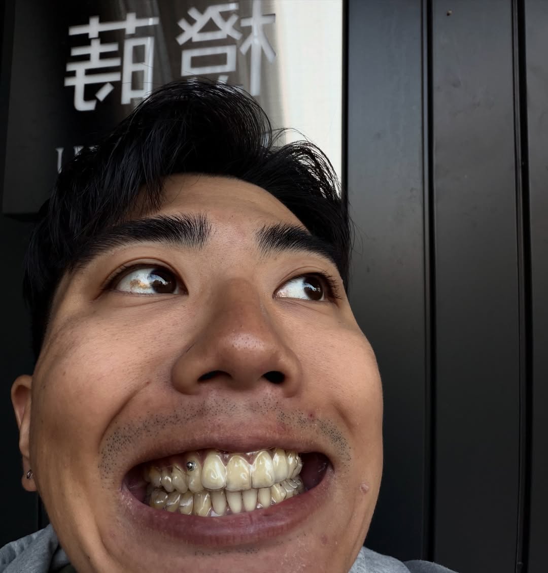 [SOV x 阿哲]告別傳統束縛：我的隱形牙套牙齒矯正之路，笑容更自信！