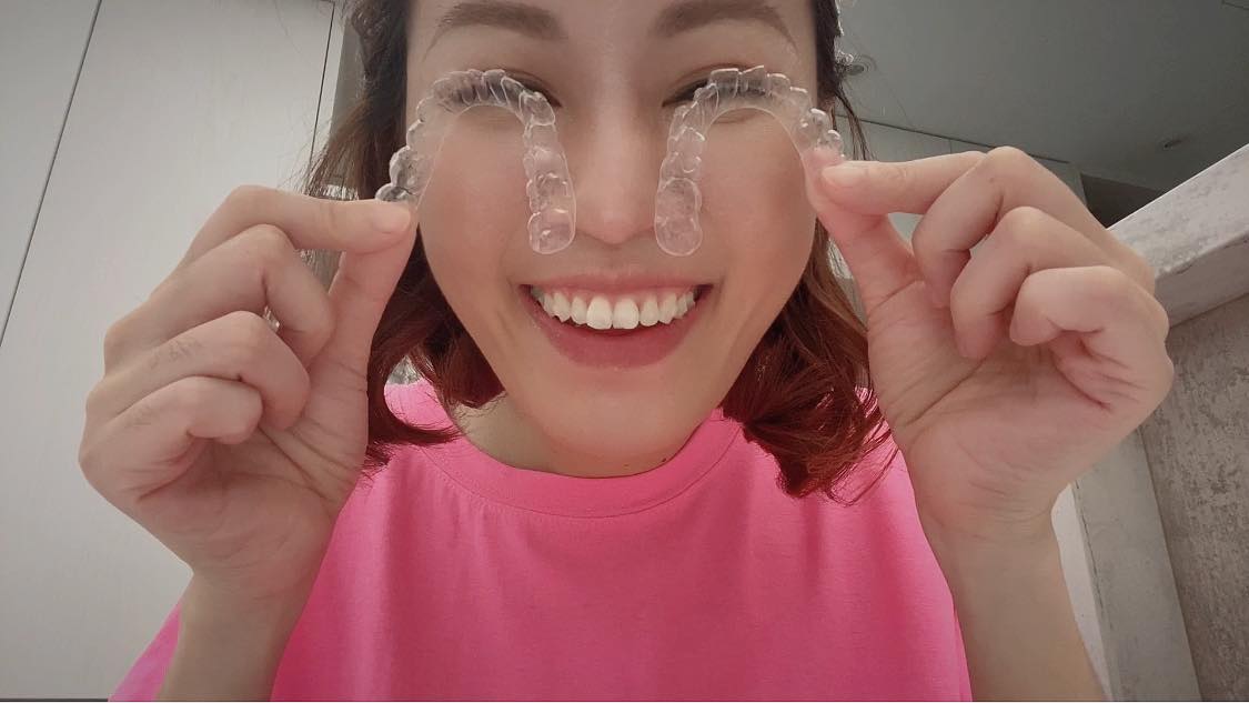 [SOV x Chiao] 我終於開始牙齒矯正惹！變美當然選擇過程不那麼壯烈的啊！