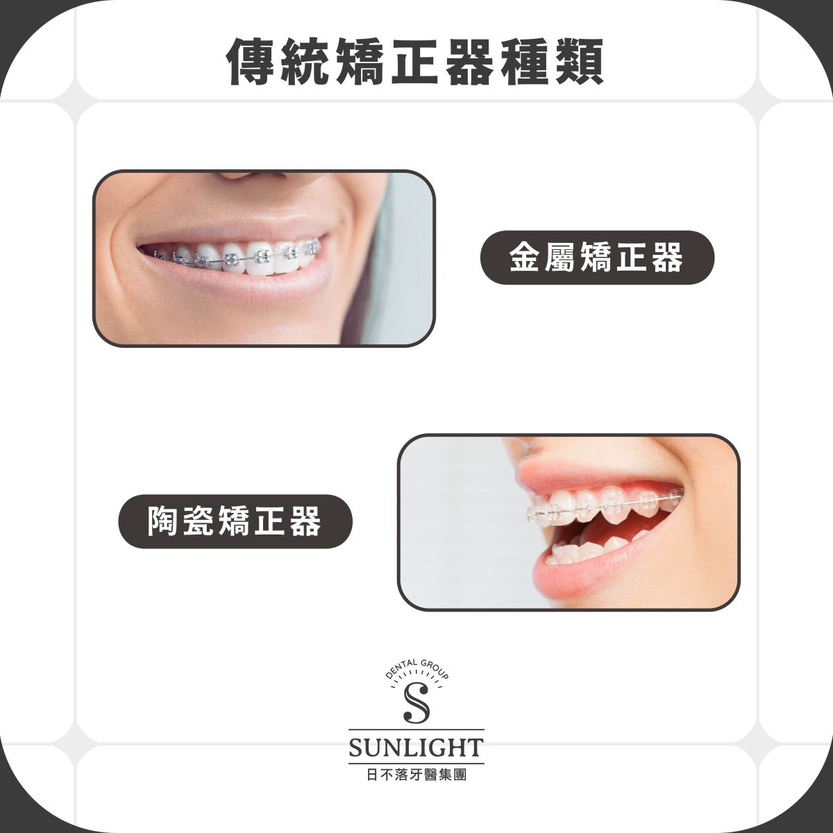 傳統牙套矯正到底有多傳統？跟戴蒙矯正或是自鎖式矯正又有甚麼差別？一篇文章解析傳統矯正的優缺點
