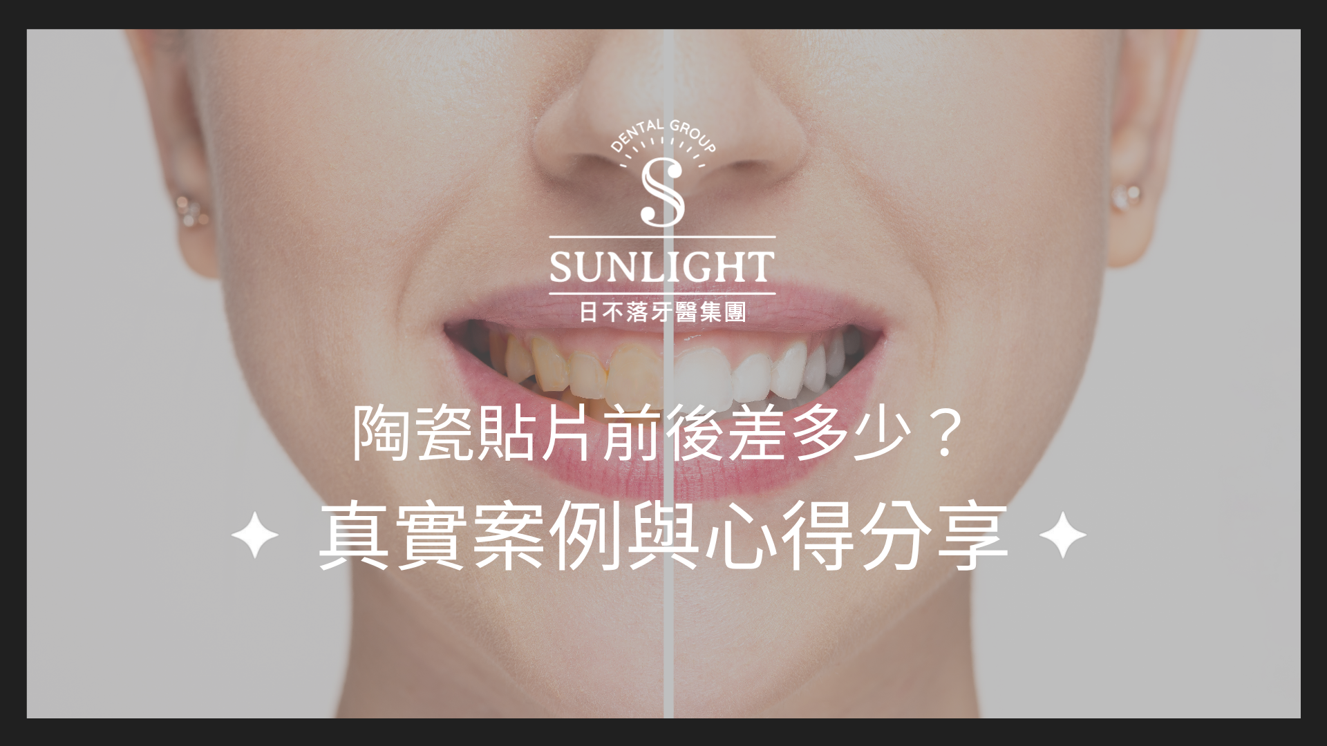 陶瓷貼片前後差多少?真實案例與心得分享