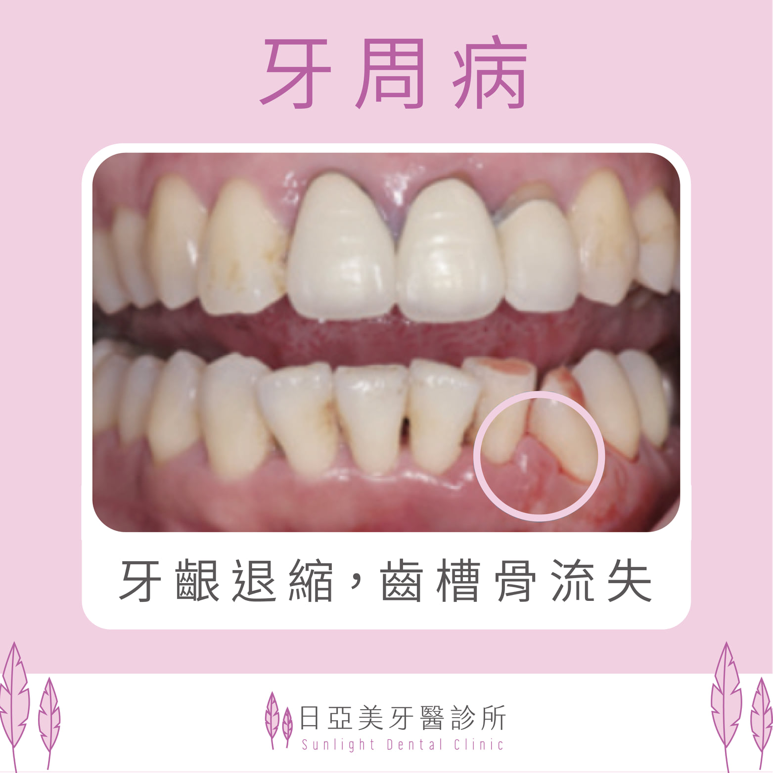 『我自己治好了我的牙周病』，這件事情是有可能的嗎？