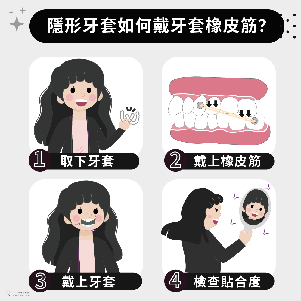 避免隱適美失敗，『牙套橡皮筋』先了解一下：尤其這3種牙齒矯正一定要戴橡皮筋！