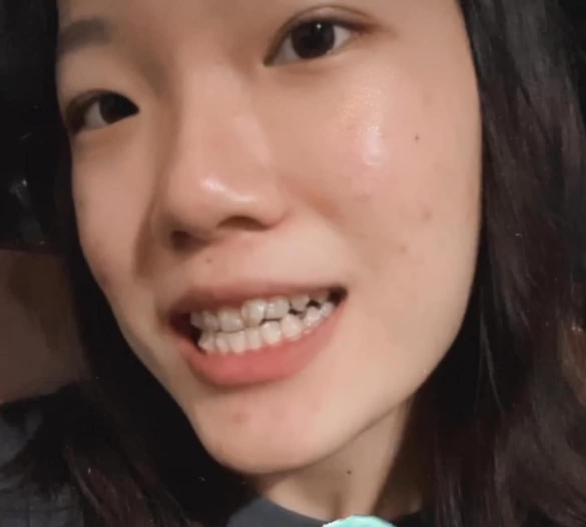 [樂齒 x 鄭宜嫻] 兩年的療程終於結束了！ 從一開始的門牙歪斜，到現在整齊的樣子，真的非常值得