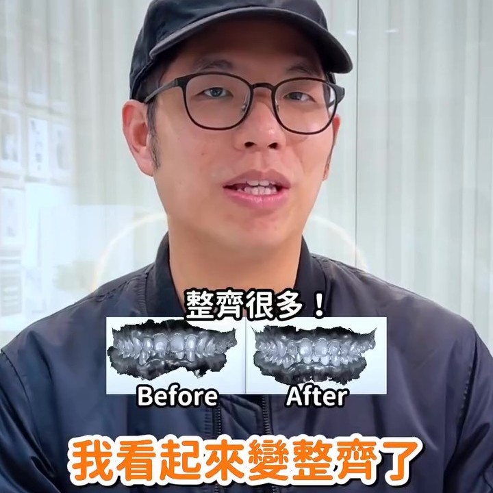 [SOV x 傑哥] SOV舒服美隱形牙套半年心得：打造整齊笑容，開啟自信蛻變的牙齒矯正體驗