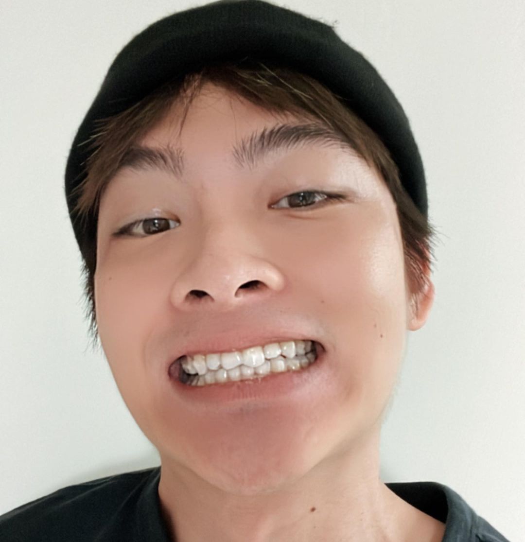 [SOV x 王庭勻] 回診時劉醫師跟我說已到了最後階段了，心中默默流下一滴淚，矯正牙齒就這樣三年過去了終於撐下來了😂