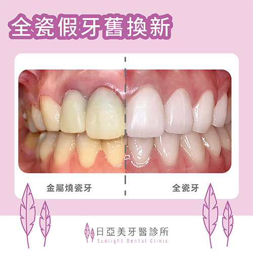 假牙周圍的牙齦為什麼黑黑的？！