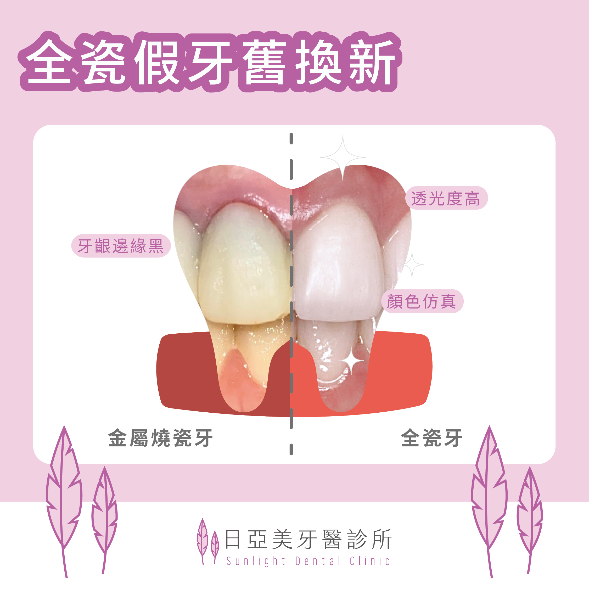 假牙周圍的牙齦為什麼黑黑的？！