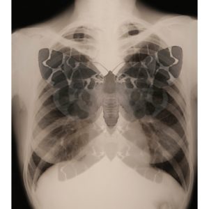Superimposed xray image of moth and chest