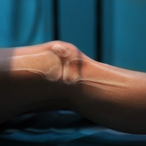 Chronic inflammation can occur in the joints and bones like the knee