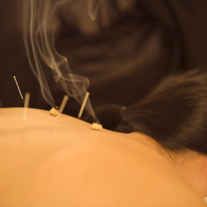 Woman receives acupuncture and moxibustion