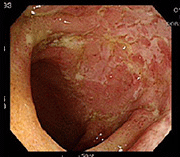 치료 전 장내 점막 사진