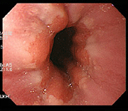 치료 전 장내 점막 사진