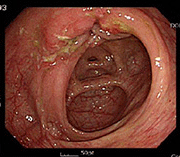 치료 전 장내 점막 사진