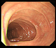 治療後 腸内粘膜回復写真