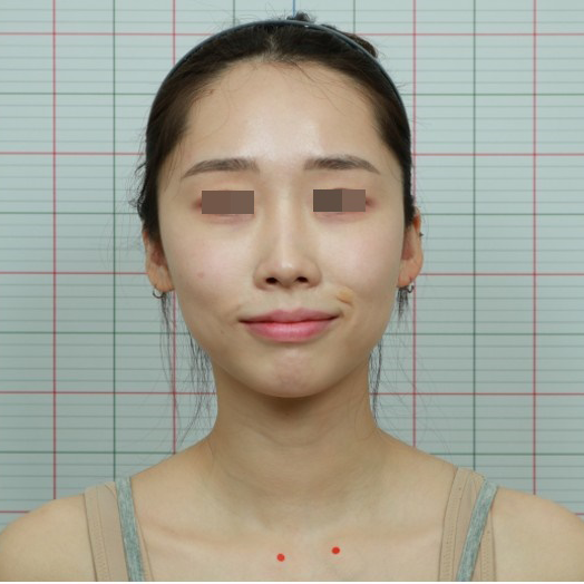 안면비대칭 시술 전 2