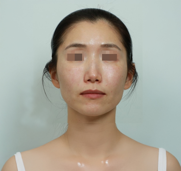 페이스 코어핏 시술 후 1