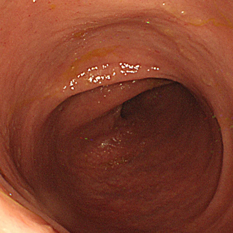 Photo of intestinal mucosal recovery after treatment