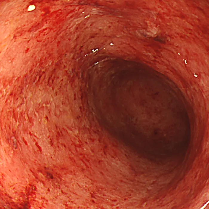 Photo of intestinal mucosa before treatment