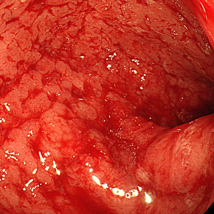 Photo of intestinal mucosa before treatment