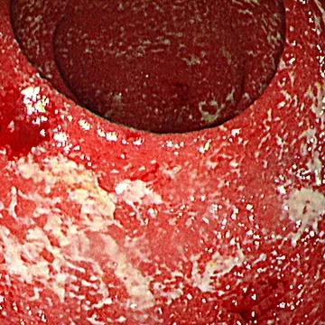 Photo of intestinal mucosa before treatment
