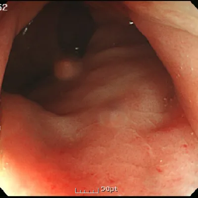 Photo of intestinal mucosal recovery after treatment