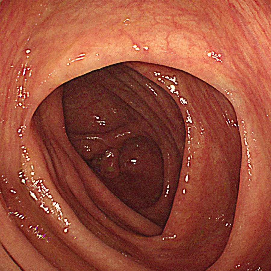 Intestinal mucosal recovery photo after treatment