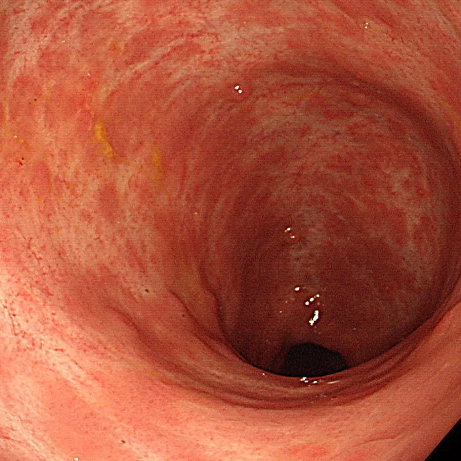 Photo of intestinal mucosal recovery after treatment
