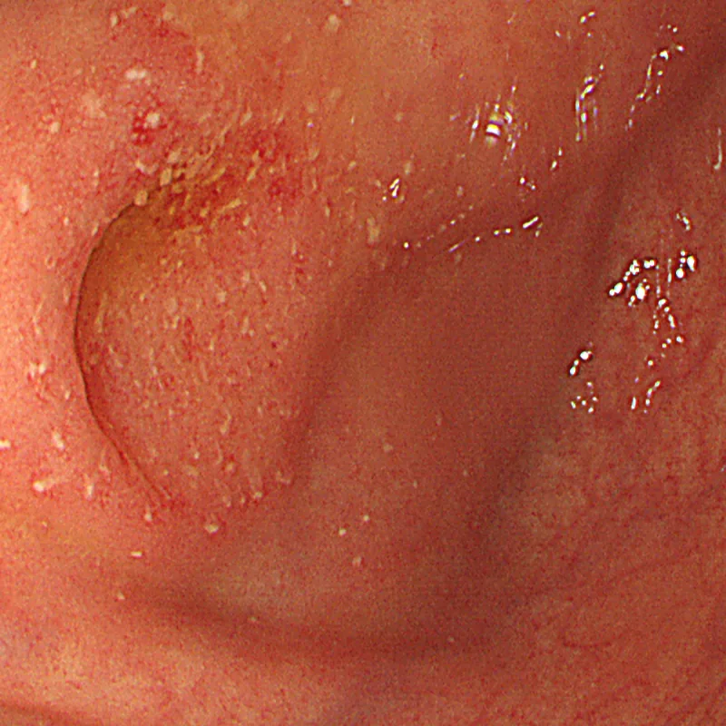 Photo of intestinal mucosa before treatment