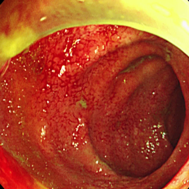 Photo of intestinal mucosa before treatment