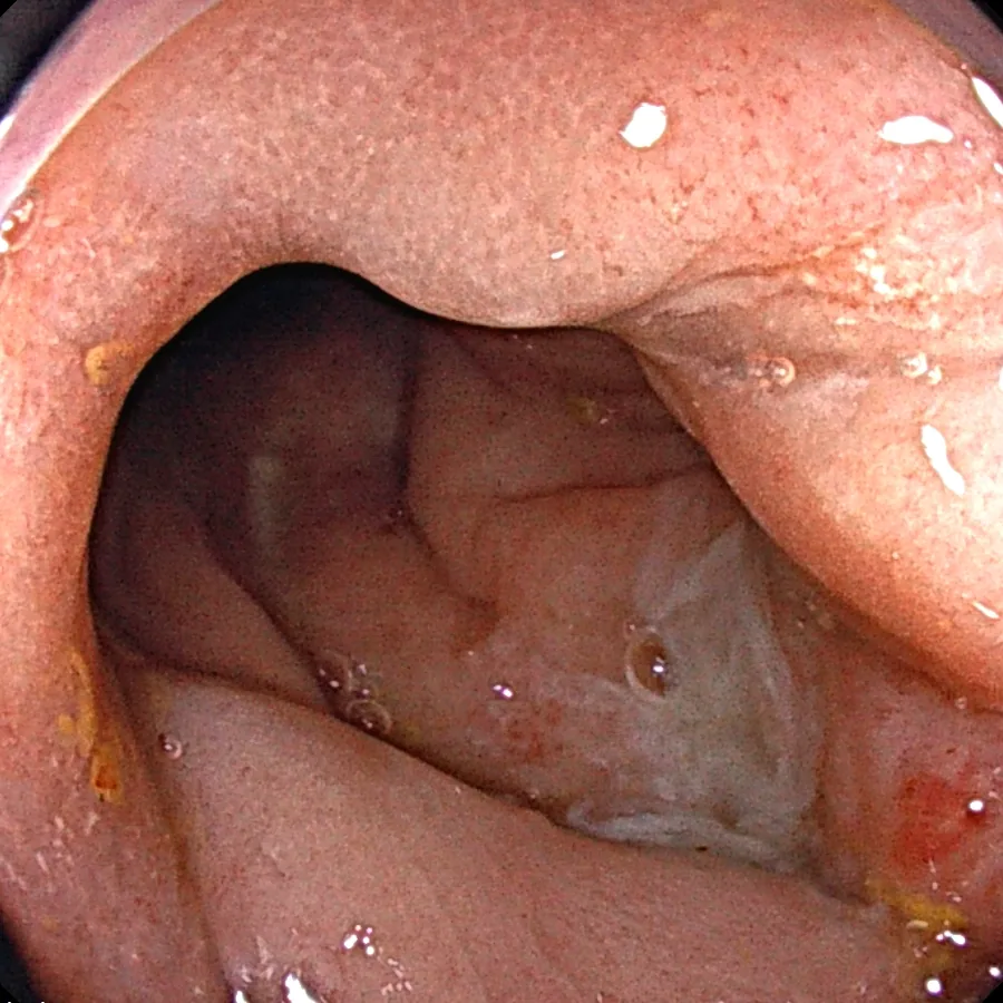 Photo of intestinal mucosal recovery after treatment